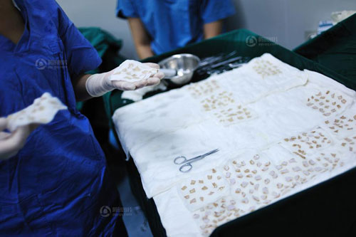 พ่อจีนยอมตัดผิวหนัง ช่วยรักษาลูกสาวถูกไฟไหม้