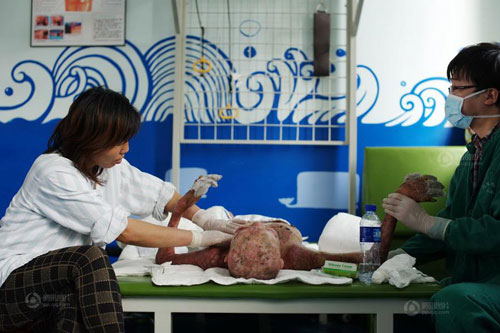 พ่อจีนยอมตัดผิวหนัง ช่วยรักษาลูกสาวถูกไฟไหม้