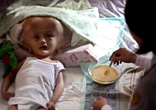 หนูน้อยอินโดป่วยแปลก หัวโตกว่าผู้ใหญ่ 3 เท่า