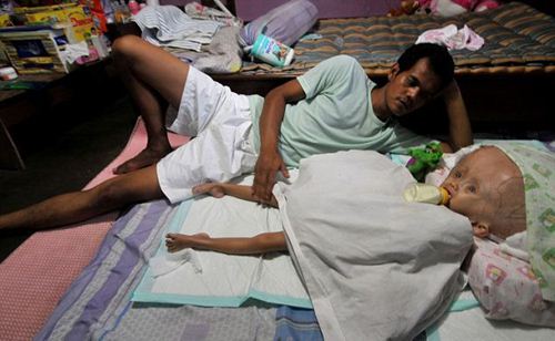 หนูน้อยอินโดป่วยแปลก หัวโตกว่าผู้ใหญ่ 3 เท่า