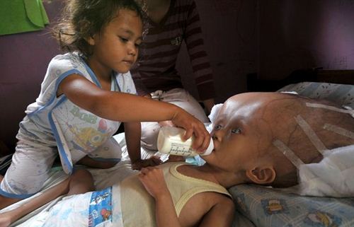 หนูน้อยอินโดป่วยแปลก หัวโตกว่าผู้ใหญ่ 3 เท่า