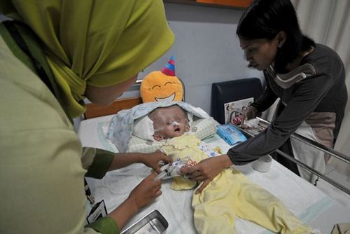 หนูน้อยอินโดป่วยแปลก หัวโตกว่าผู้ใหญ่ 3 เท่า