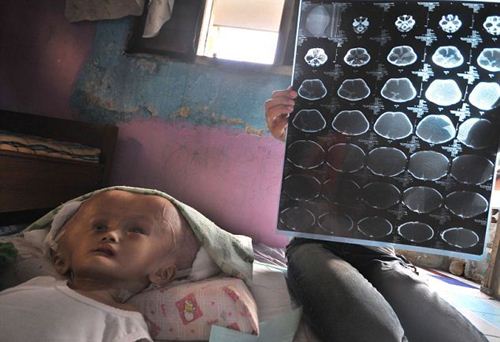 หนูน้อยอินโดป่วยแปลก หัวโตกว่าผู้ใหญ่ 3 เท่า