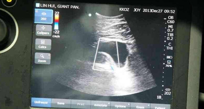 หลินฮุ่ยท้อง