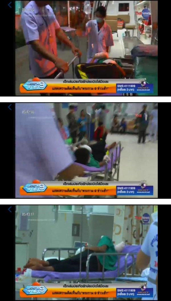 เด็กชายวัย 12 ปี เล่นประทัดระเบิดใส่มือขาด