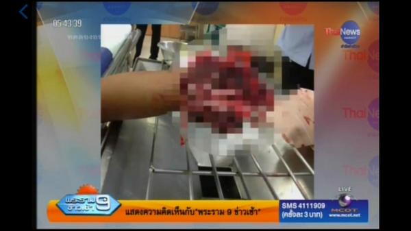 เด็กชายวัย 12 ปี เล่นประทัดระเบิดใส่มือขาด