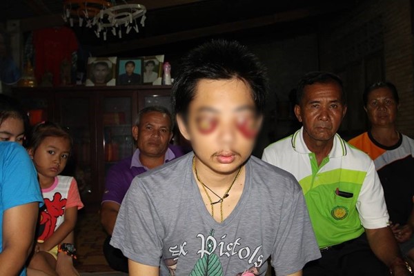 ป่วยเนื้องอกที่ตา-เบ้าตาถลน