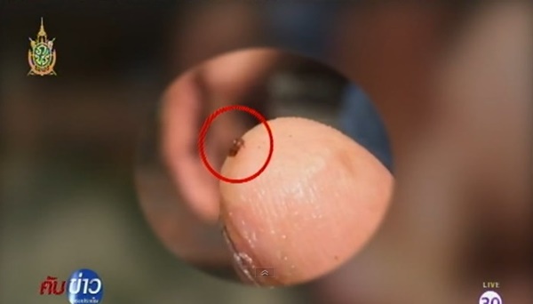 มีแมลงโผล่จากผิวหนัง