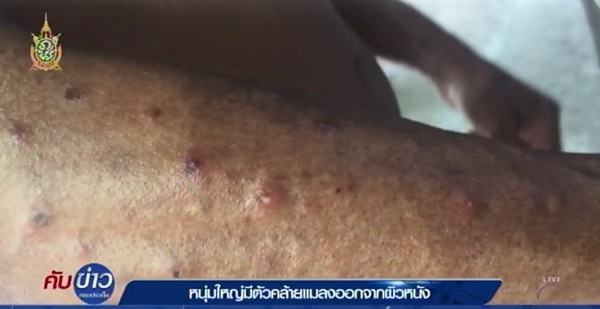 มีแมลงโผล่จากผิวหนัง