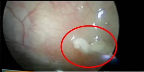 เด็ก 3 ขวบพยาธิเต็มท้อง