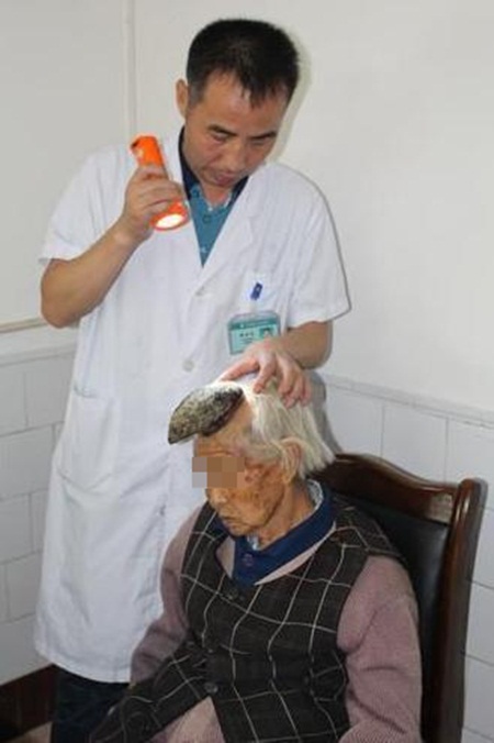 หญิงชราชาวจีนมีเขางอกกลางหัว