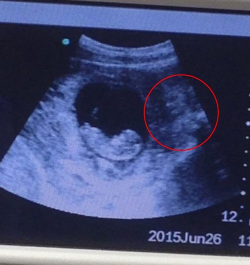 เงาปีศาจโผล่ภาพถ่ายอัลตราซาวด์