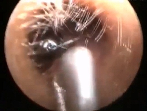 มดทำรังในหูเด็กหญิง