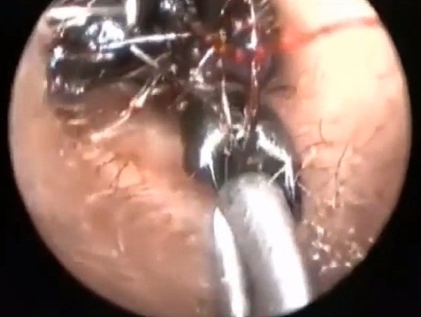 มดทำรังในหูเด็กหญิง