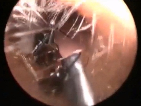 มดทำรังในหูเด็กหญิง