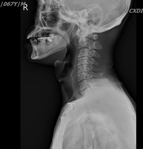 ฟันปลอม