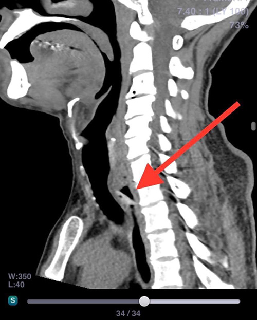 ฟันปลอม