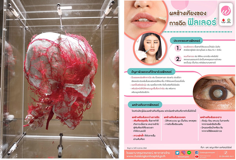 ฟิลเลอร์ปลอม