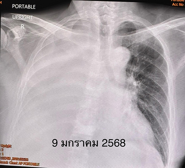 มะเร็งปอด