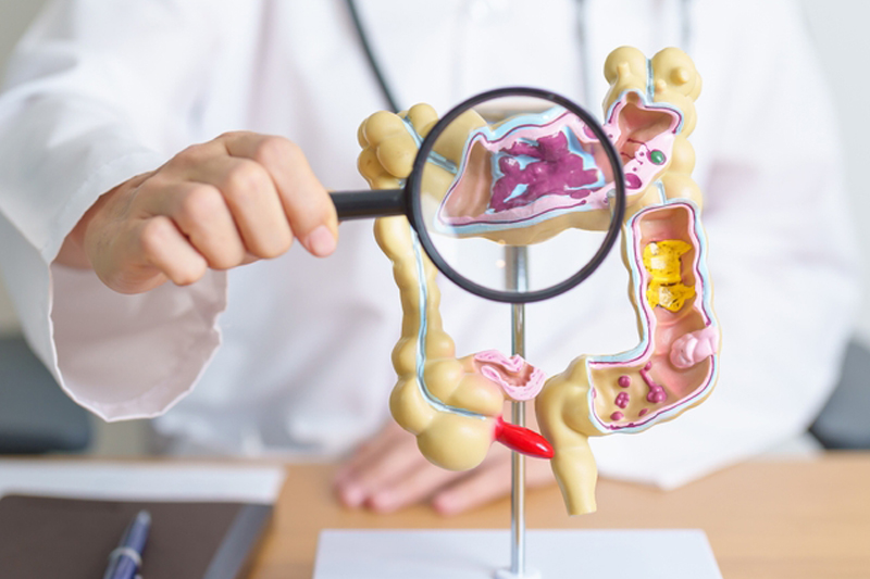 มะเร็งลำไส้