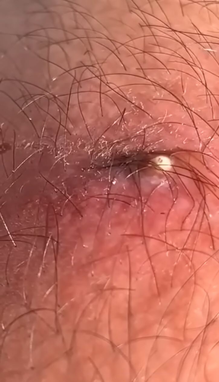 หนุ่มไทยเจอตุ่มปริศนาที่ขา ช็อกว่าเป็นตัวอ่อนแมลงวันไชผิว