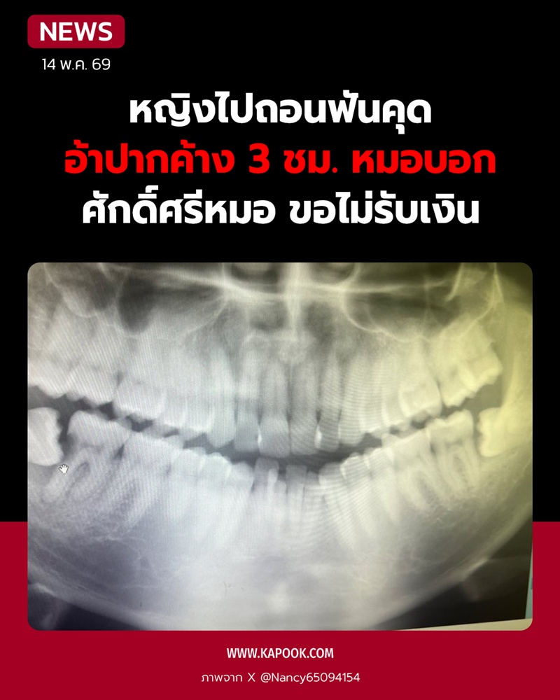 ถอนฟันคุด