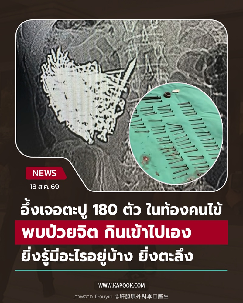 เจอแม่เหล็ก - เหรียญ - ตะปู ในท้อง เจอแม่เหล็ก - เหรียญ - ตะปู ในท้อง