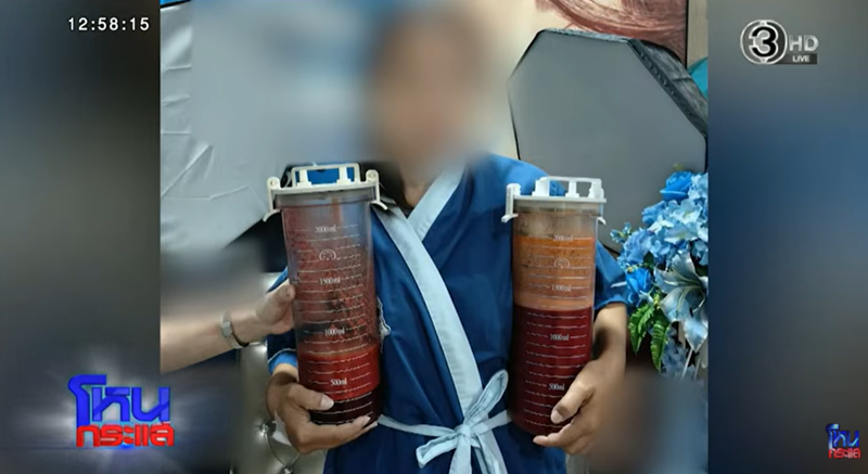 ดุดไขมัน ดุดไขมัน
