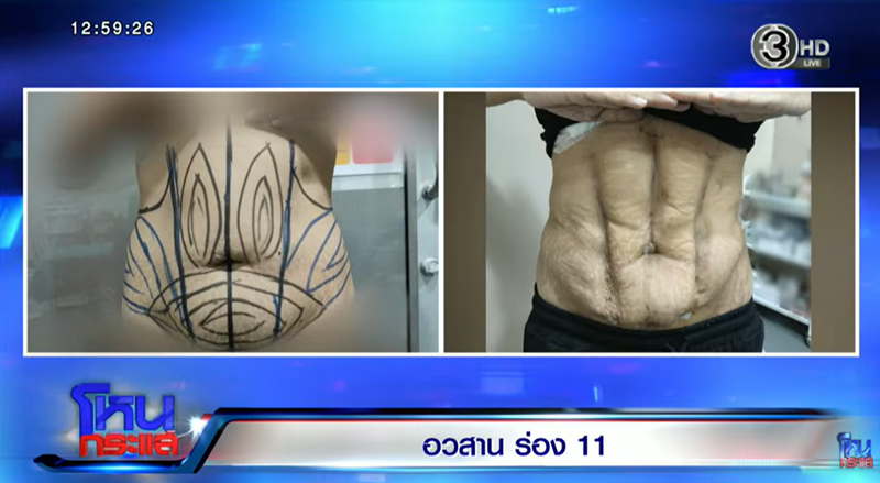 ดุดไขมัน ดุดไขมัน