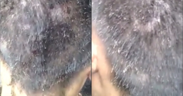 เห็นแล้วคันแทน หนุ่มคนนี้เหายั้วเยี้ยเต็มหัว ไม่ได้สระนานกี่ปีล่ะนี่