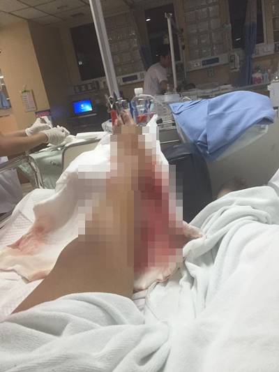 โดนตัดขา