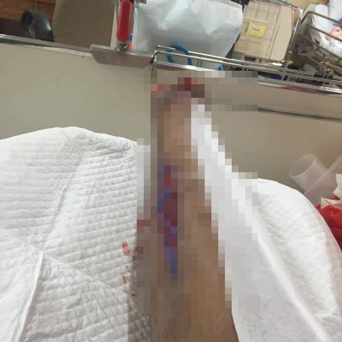 โดนตัดขา