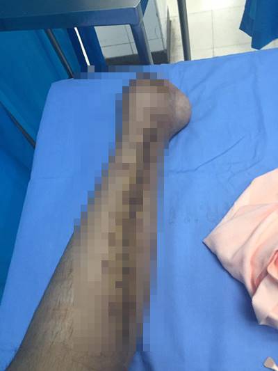 โดนตัดขา