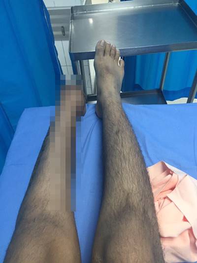 โดนตัดขา