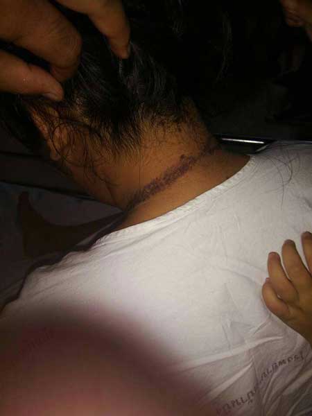 โดนฟ้าผ่า