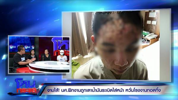 เตาสารเคมีระเบิดใส่หน้า