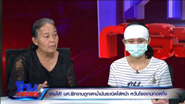 เตาสารเคมีระเบิดใส่หน้า