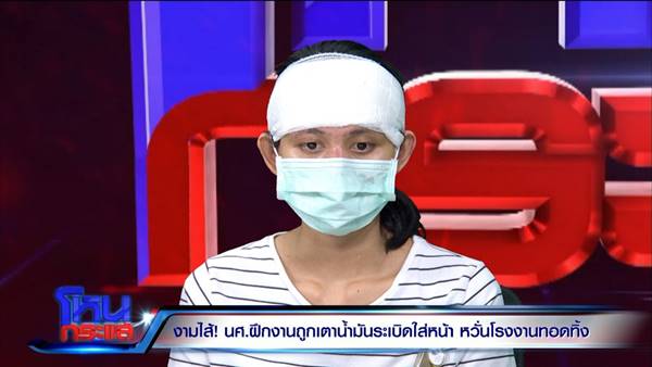 เตาสารเคมีระเบิดใส่หน้า