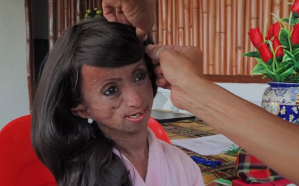 โรคแก่ก่อนวัย