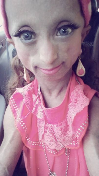 โรคแก่ก่อนวัย