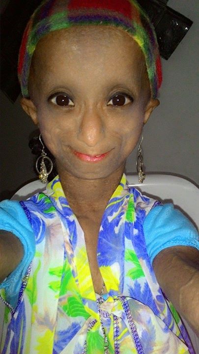 โรคแก่ก่อนวัย