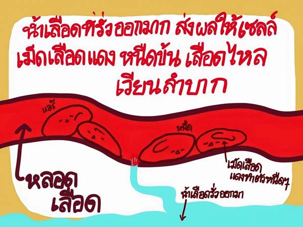 การ์ตูนโรคไข้เลือดออก