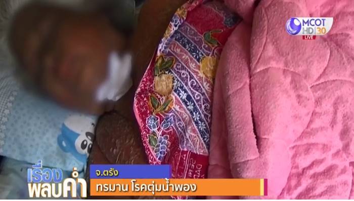 โรคตุ่มน้ำพอง