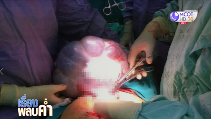 ผ่าตัดก้อนเนื้อรังไข่