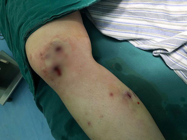 หนอนไชขา