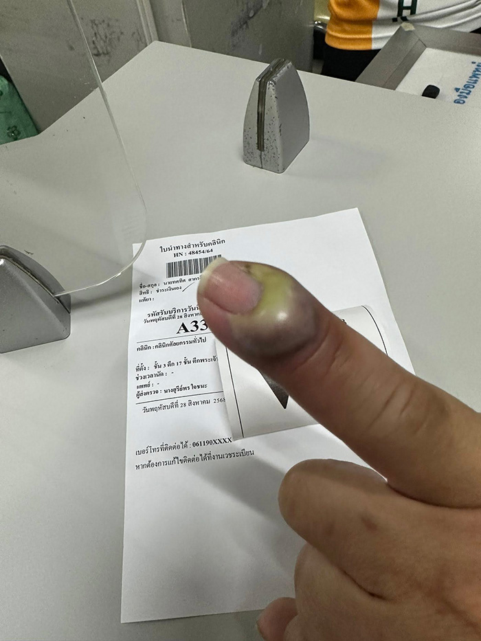 เกือบเสียนิ้ว เพราะแมวข่วน