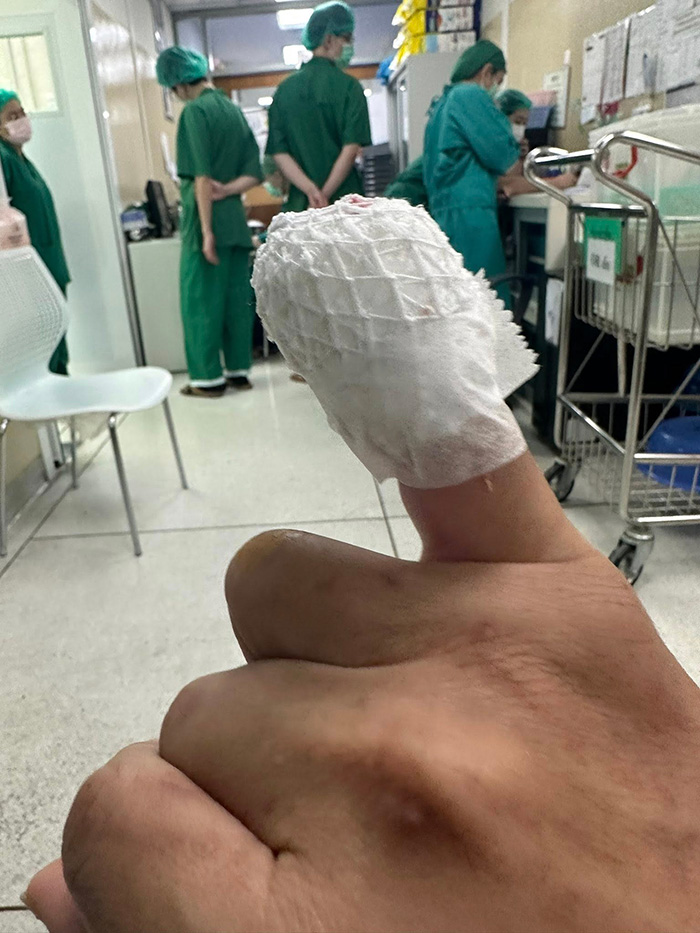 เกือบเสียนิ้ว เพราะแมวข่วน