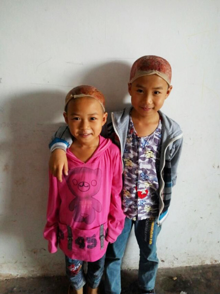 เด็กน้อยสองพี่น้องแสนกตัญญู บริจาคหนังศีรษะเพื่อช่วยพ่อที่ถูกไฟคลอก