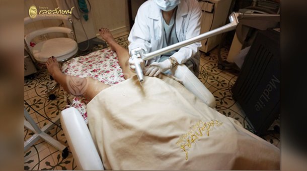 เลเซอร์น้องสาว