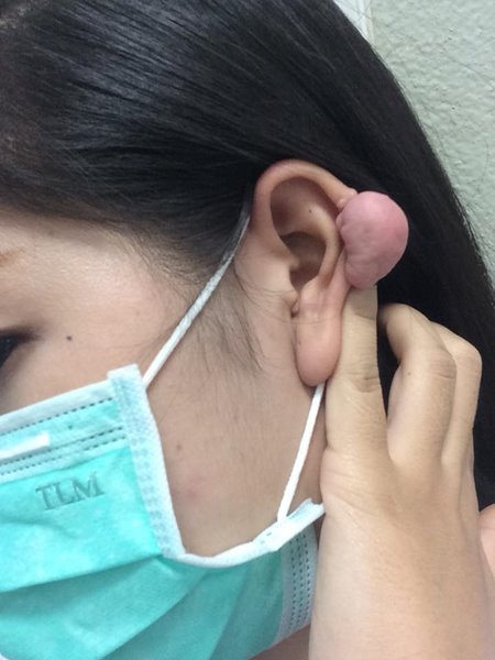 คีลอยด์